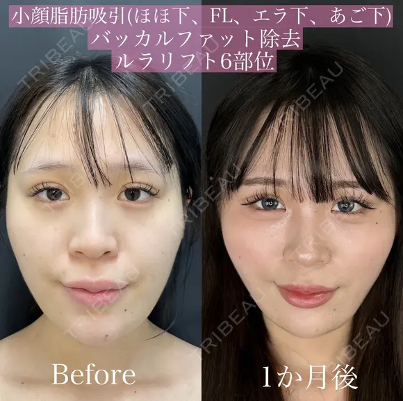 顔脂肪吸引（ホホフェイスライン、アゴ下エラ下）・バッカルファット除去・ルラリフト6部位 before画像 メイン用