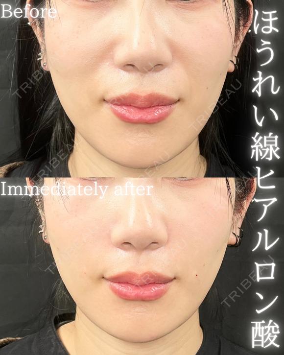 ほうれい線ヒアルロン酸 before画像 メイン用