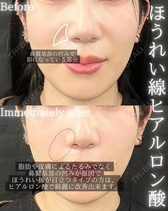 ほうれい線ヒアルロン酸 after画像 メイン用