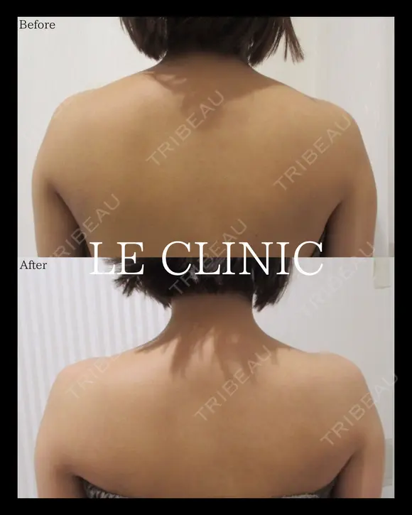 肩ボトックス before画像 メイン用