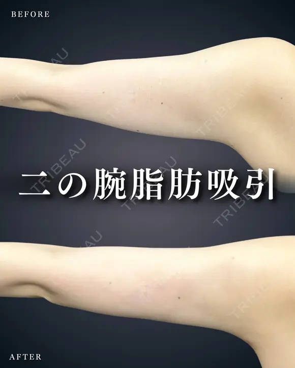 二の腕脂肪吸引 after画像 メイン用