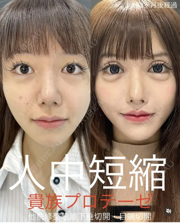 人中短縮・貴族プロテーゼ・眼瞼下垂・目頭切開 after画像 メイン用