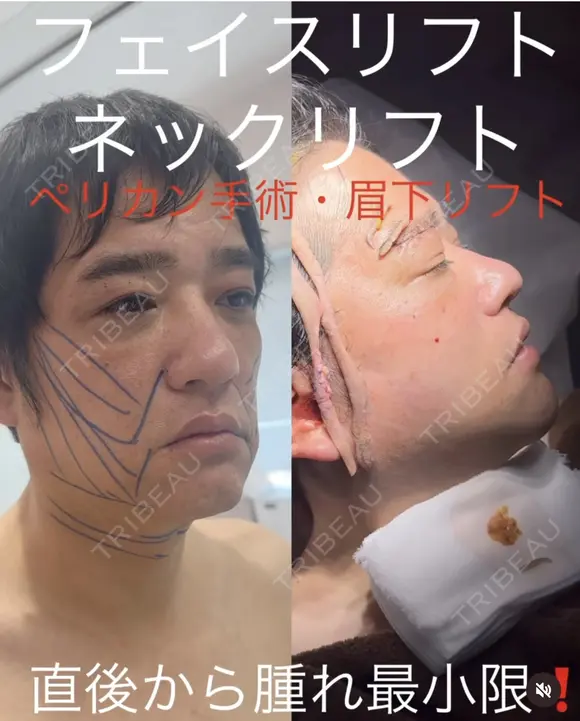 フェイスリフト・ネックリフト・ペリカン手術・眉下リフト before画像 メイン用
