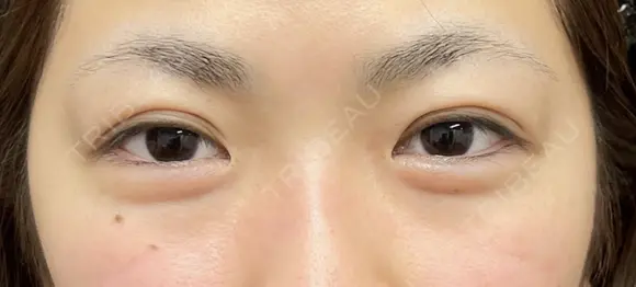 二重埋没3点留め 30日後 メイン用