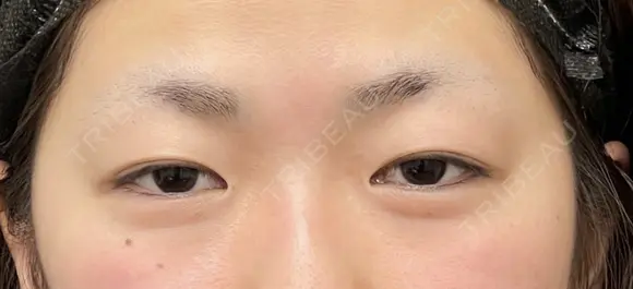 二重埋没3点留め before画像 メイン用