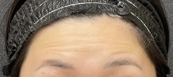 額ボトックス before画像 メイン用