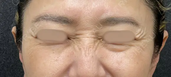 鼻筋ボトックス before画像 メイン用