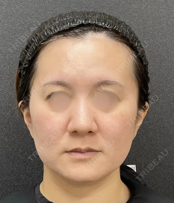 PDO糸リフト before画像 メイン用
