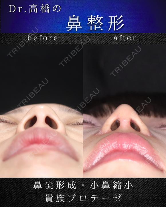 鼻尖形成・小鼻縮小・貴族プロテーゼ before画像 メイン用