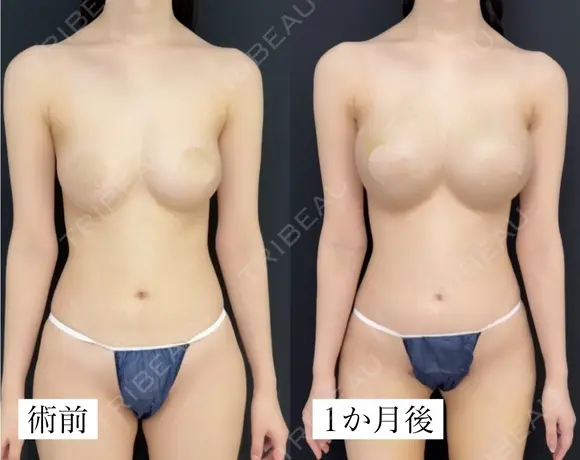 コンデンスリッチ脂肪豊胸 30日後 メイン用