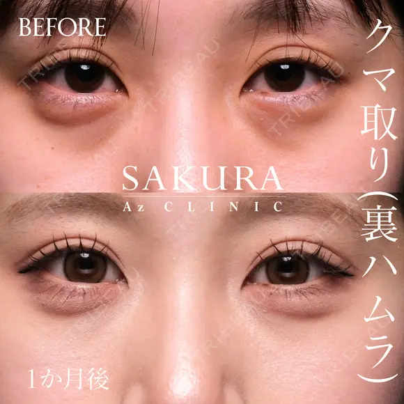 クマ取り(裏ハムラ法) before画像 メイン用