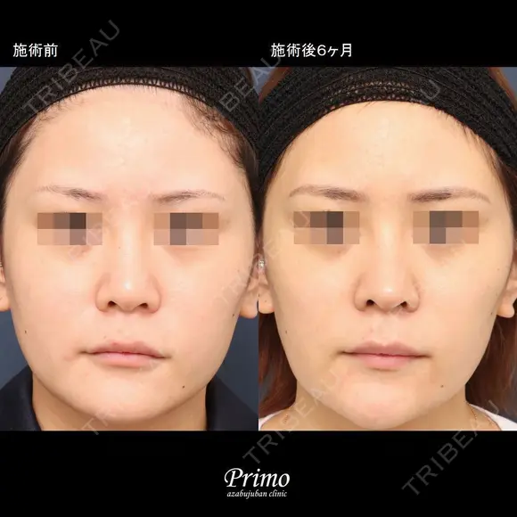 JJ 鼻中隔延長術＋鼻背部軟骨移植術 before画像 メイン用