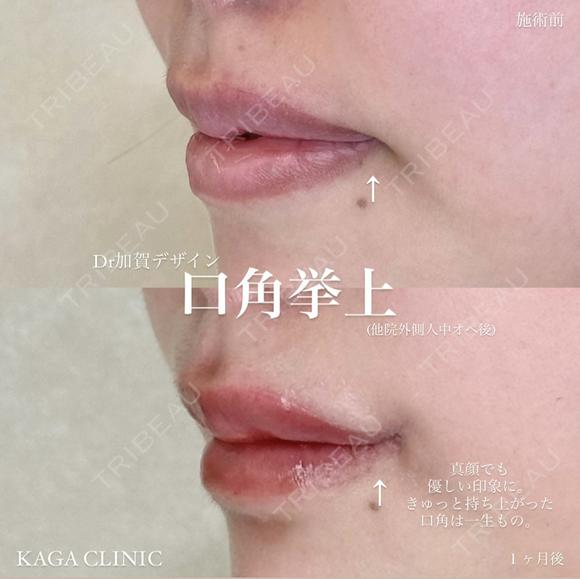 加賀デザイン×口角挙上 after画像 メイン用