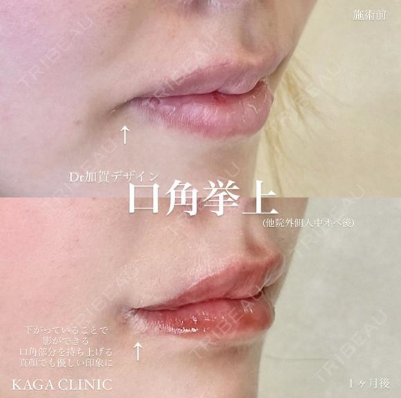 加賀デザイン×口角挙上 after画像 メイン用