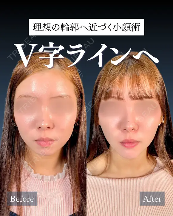 岩﨑先生による🔥小顔整形🔥 before画像 メイン用