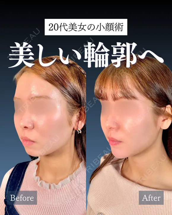 岩﨑先生による🔥小顔整形🔥 before画像 メイン用