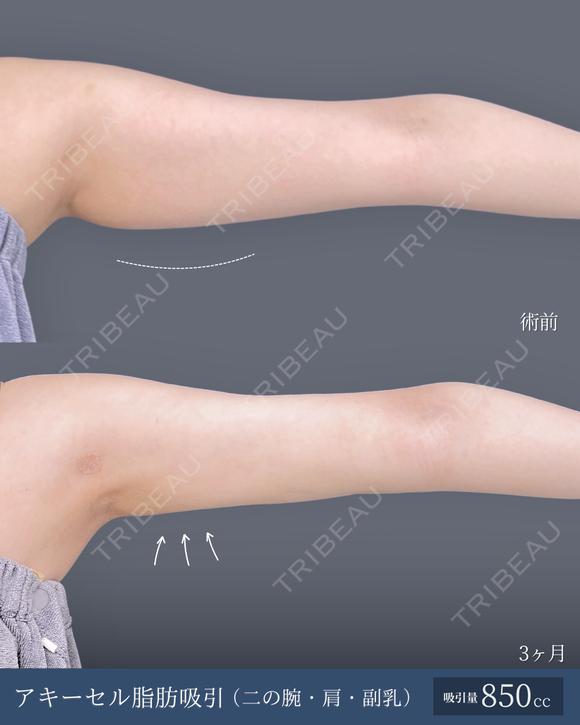 アキーセル脂肪吸引(二の腕・肩・副乳) before画像 メイン用
