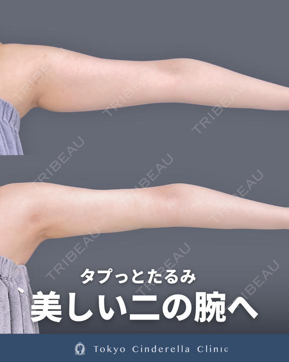 アキーセル脂肪吸引(二の腕・肩・副乳) 90日後 メイン用