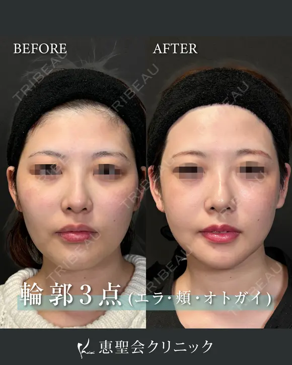輪郭3点（頬・エラ・オトガイ骨切り） before画像 メイン用