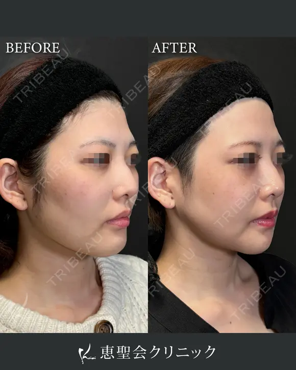 輪郭3点（頬・エラ・オトガイ骨切り） after画像 メイン用