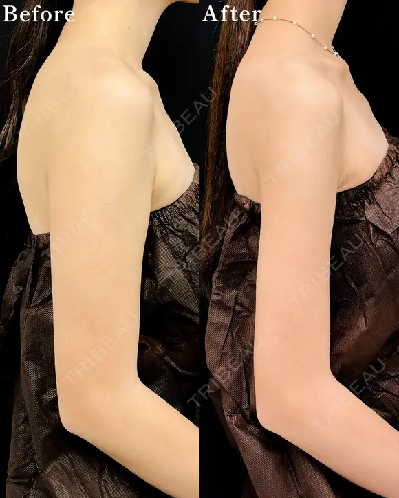 【二の腕】ベイザー併用アキーセル脂肪吸引 after画像 メイン用