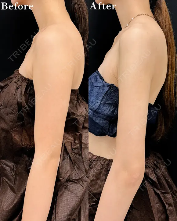 【二の腕】ベイザー併用アキーセル脂肪吸引 after画像 メイン用