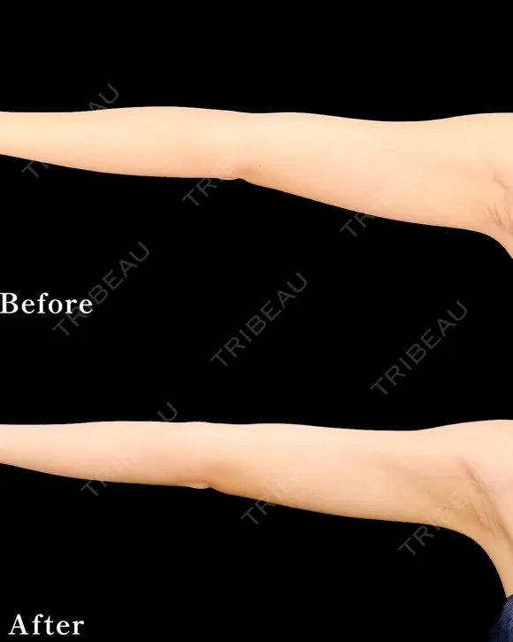 【二の腕】ベイザー併用アキーセル脂肪吸引 after画像 メイン用