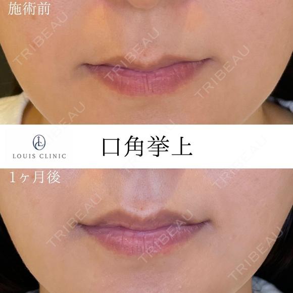 口角挙上 before画像 メイン用