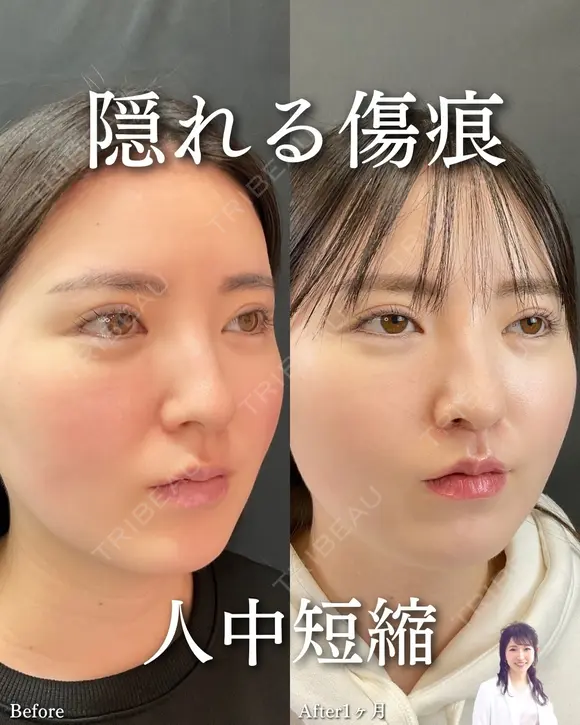 人中短縮 after画像 メイン用