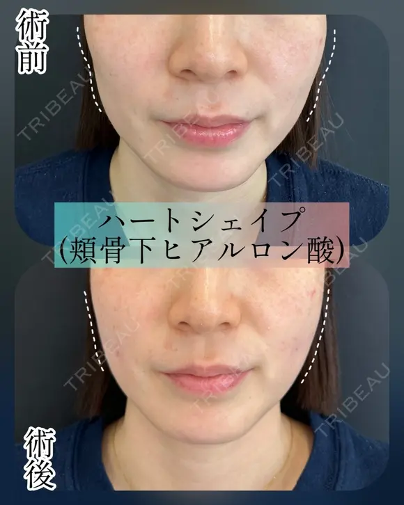 ハートシェイプ（頬骨下ヒアルロン酸） before画像 メイン用