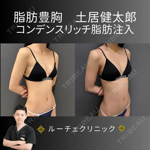 コンデンスリッチ脂肪豊胸 after画像 メイン用