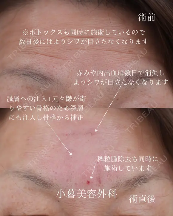 額ヒアルロン酸　眉間ヒアルロン酸 before画像 メイン用