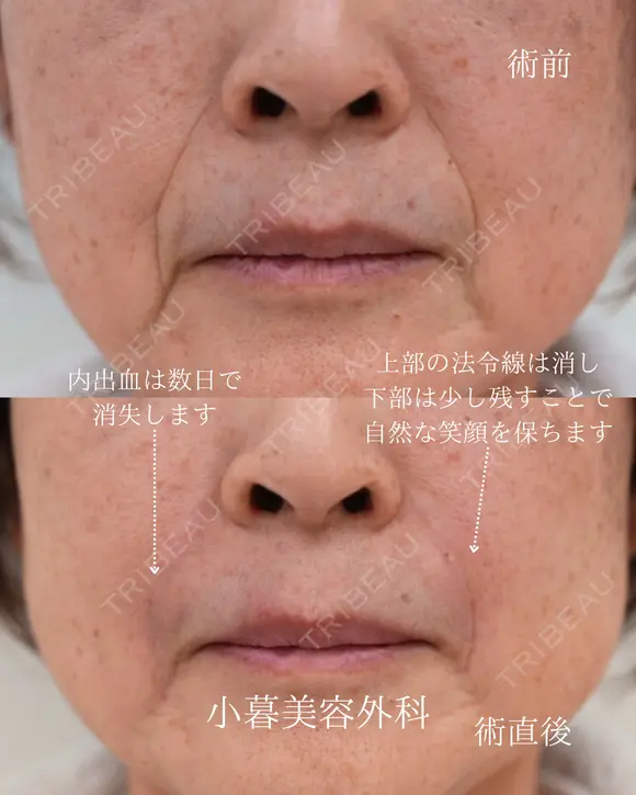 法令線ヒアルロン酸 before画像 メイン用