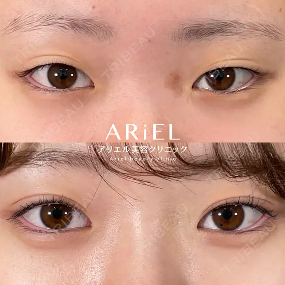 アリエルクイックループ（二重埋没法）＋鼻ヒアルロン酸 before画像 メイン用