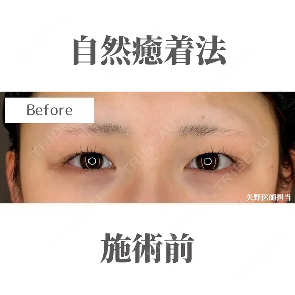 自然癒着法 before画像 メイン用
