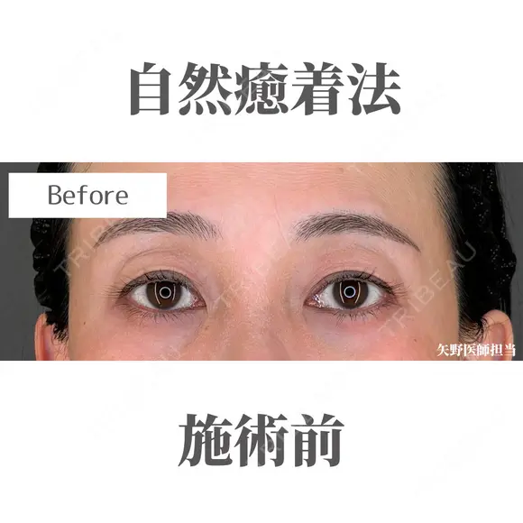 自然癒着法 before画像 メイン用