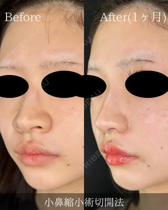 小鼻縮小切開法(内側) before画像 メイン用