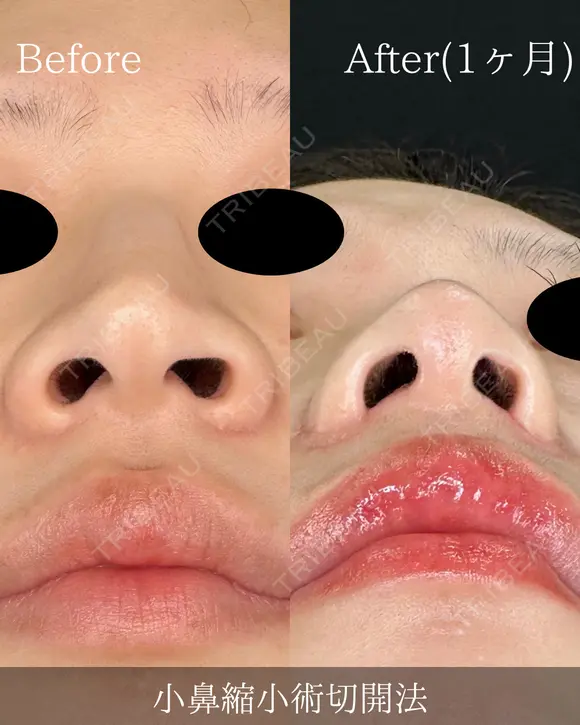 小鼻縮小切開法(内側) after画像 メイン用