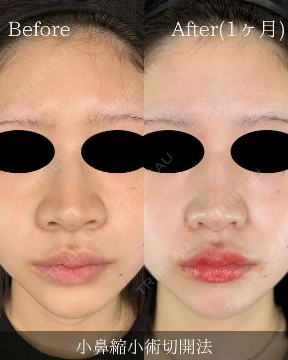 小鼻縮小切開法(内側) after画像 メイン用