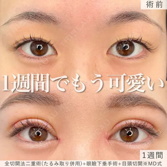 1週間でもう可愛い♡MD式全切開法二重術+MD式眼瞼下垂手術※たるみ取り併用 before画像 メイン用