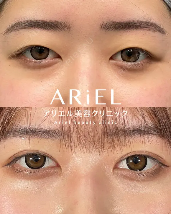 アリエルクイックループ（二重埋没法） before画像 メイン用
