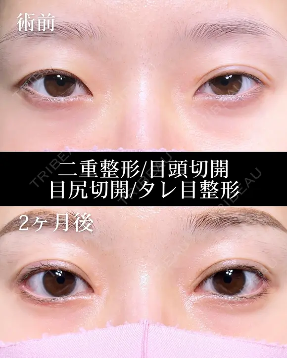 二重埋没法/目頭切開/目尻切開/タレ目整形 before画像 メイン用