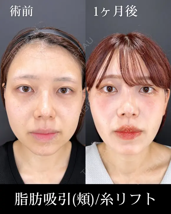 脂肪吸引(頬)/糸リフト 30日後 メイン用