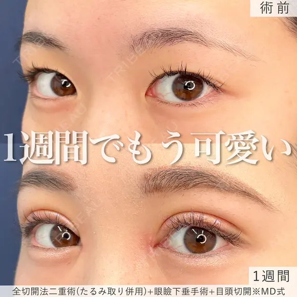 1週間でもう可愛い♡MD式全切開法二重術+MD式眼瞼下垂手術※たるみ取り併用 before画像 メイン用
