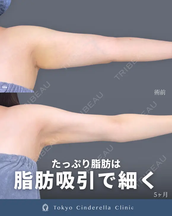 シンデレラ脂肪吸引(二の腕・肩) 150日後 メイン用
