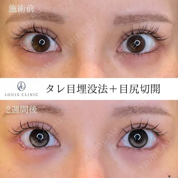 タレ目＋目尻切開 14日後 メイン用