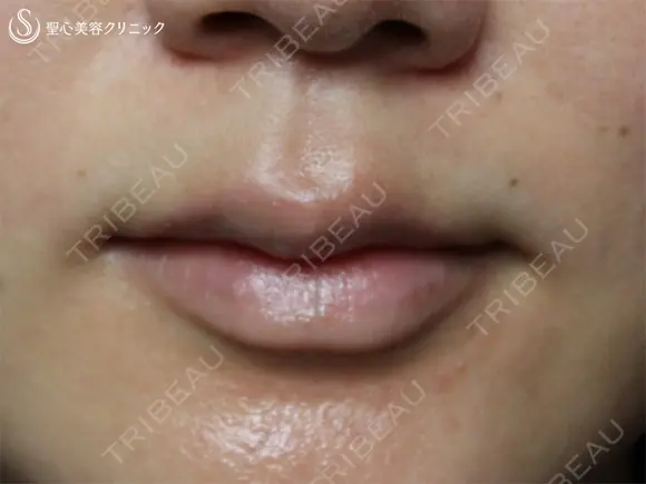 【20代女性・自然な印象の良い口元に】プレミアム口角挙上術（1ヶ月後） before画像 メイン用