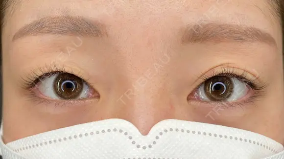 ネクサスアイズ before画像 メイン用