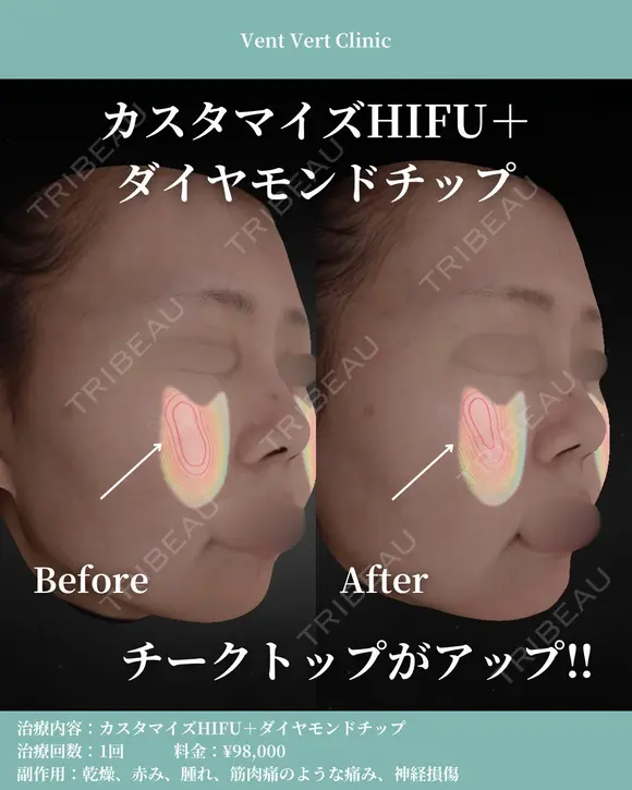 HIFU＋ダイヤモンドチップ before画像 メイン用