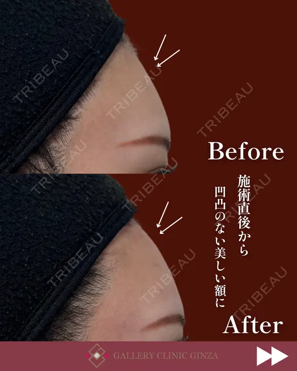ヒアルロン酸（額） before画像 メイン用